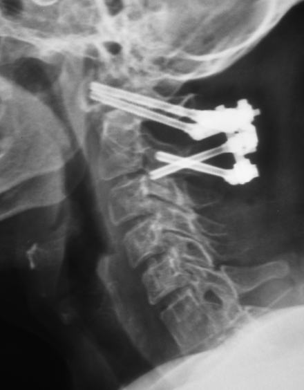 C1-C2 Posterior Segmental Fiksasyon