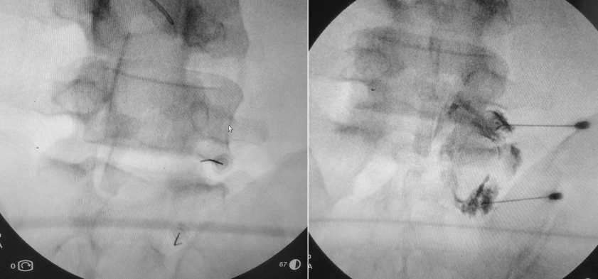 lomber-disk-hernisi-bel-bacak-agrisi-transforaminal-epidural-enjeksiyon-xray